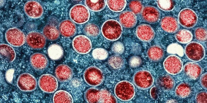 Health officials track Arizona’s first travel-associated case of Clade I mpox