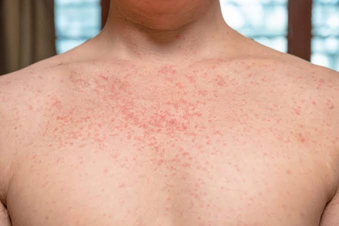 Health Officials Caution Fliers of Measles Exposure at LAX