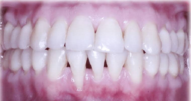 Management of Multiple Mandibular Gingival Recessions Following Orthodontic Treatment Using a Connective Tissue Graft and a Coronally Advanced Flap: A Case Report