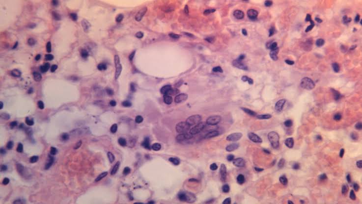Measles warning issued across DMV region following confirmed case