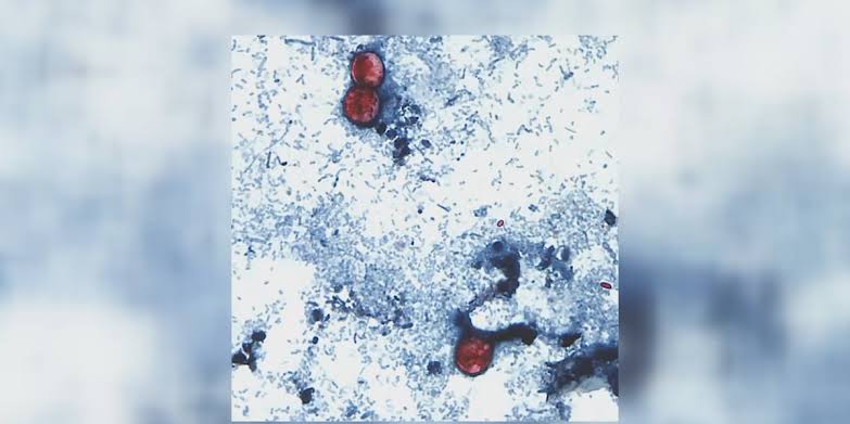 Cyclosporiasis outbreak in Michigan grows to nearly 700 cases