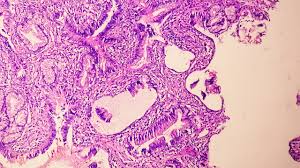 PSA levels alone may not reflect prostate cancer growth