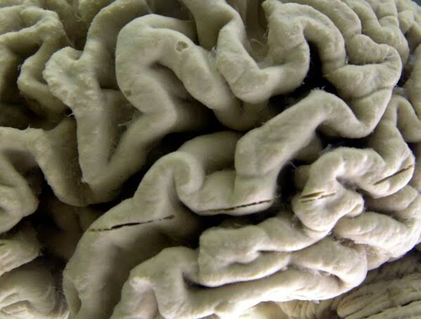 Study shows a blood test can help identify healthy people at high risk for Alzheimer's disease