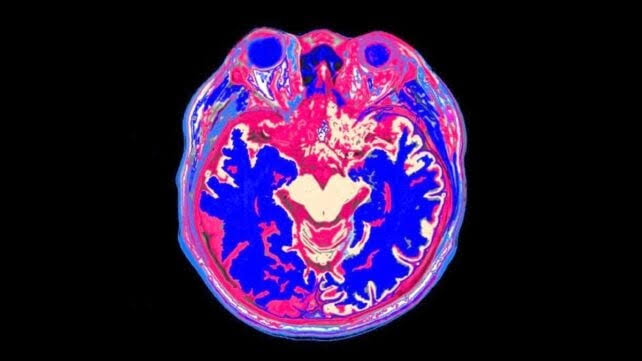 Bad News For Bingers: Watching Too Much TV Linked to Smaller Brain Volume