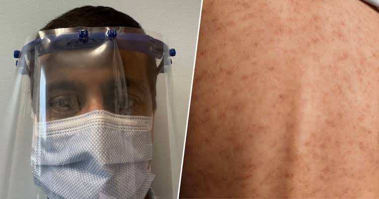 I’m an Infectious Disease Doctor Who Treated Measles in the 2015 Outbreak. 7 Things People Keep Getting Wrong