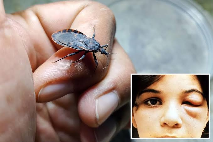 Case of deadly 'kissing bug' found in California -- and sufferers may not even know they have it