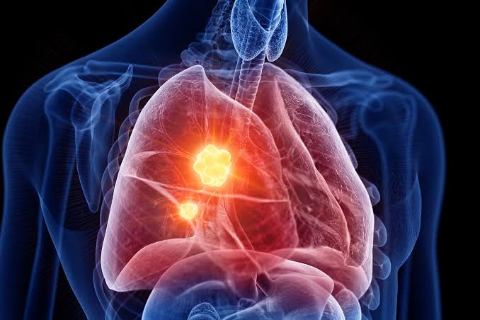 A Rare and Deadly Cancer May Have an Unexpected New Vulnerability