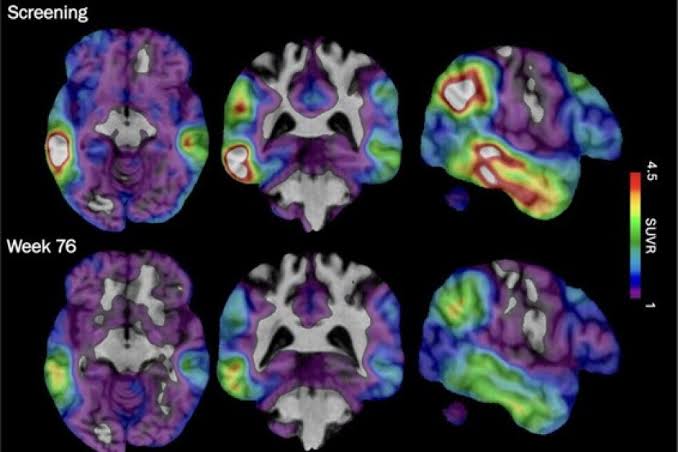 An experimental Alzheimer's drug shows promise targeting a different brain protein, new study shows