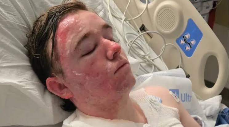 McDonald’s worker suffers severe burns on face and body after co-worker throws hot oil on him, family says