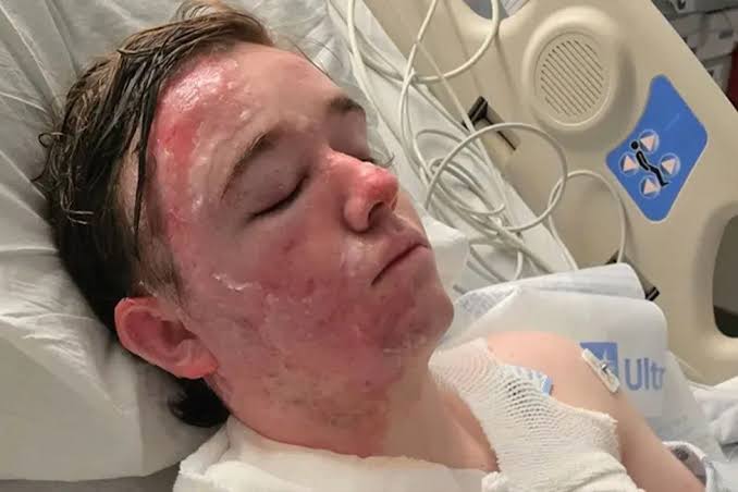 McDonald’s Employee in ICU with Second-Degree Burns After Co-Worker Allegedly Threw Hot Oil on Him