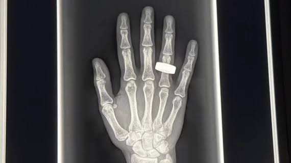 Portable system captures 1st diagnostic-quality X-rays during spaceflight