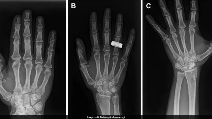First Human X-Rays Captured In Space Mark Major Breakthrough For Astronaut Health