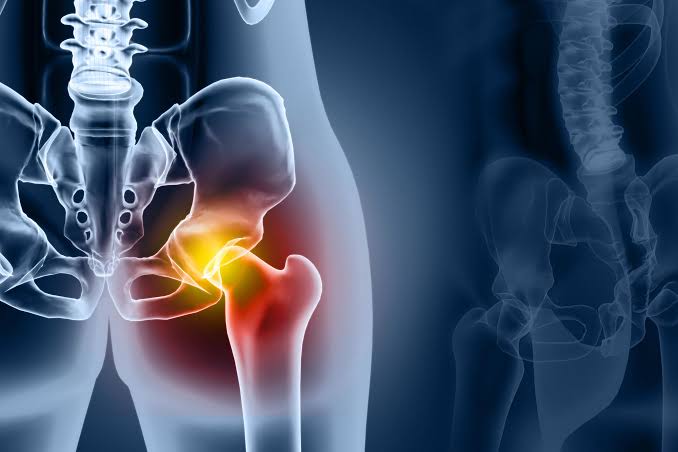 Hip Replacements Are Lasting Far Longer Than Doctors Once Thought