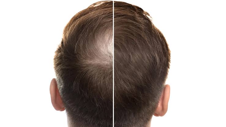 Ancient Chinese medicine could transform hair loss treatment