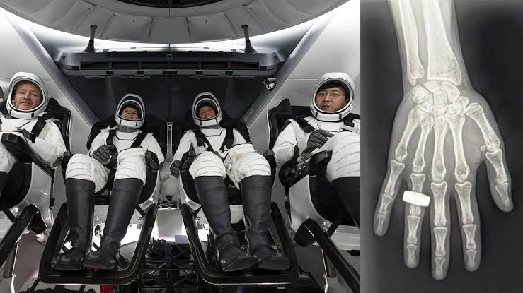 Astronauts Obtain First X-Rays in Space