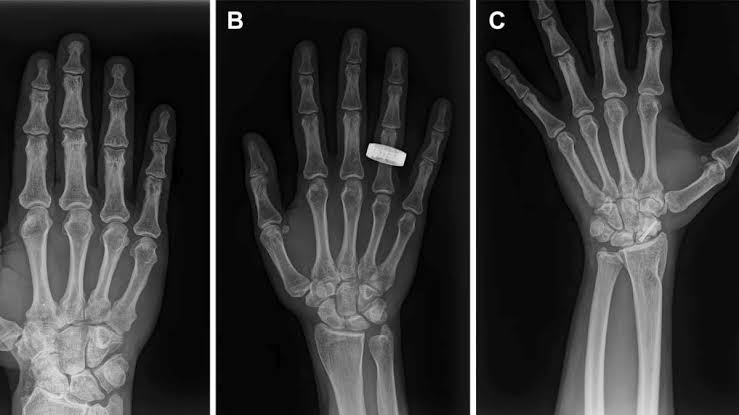 Astronauts Have Taken The First Human X‑Rays in Space
