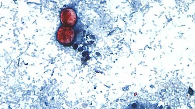 Cyclospora in Maryland: Cases more than double since last week